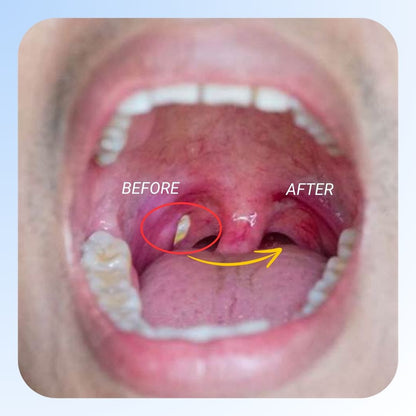 Precision Tonsil Stone Removal Kit